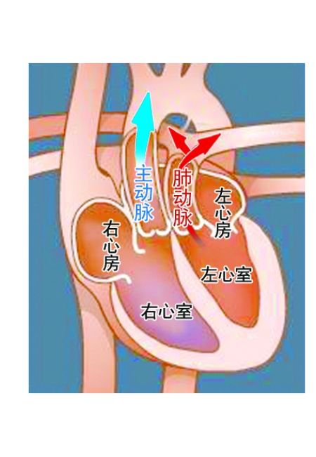 完全性大動脈轉(zhuǎn)位