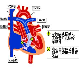 主-肺動(dòng)脈間隔缺損
