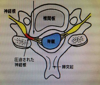 神經(jīng)根型頸椎病