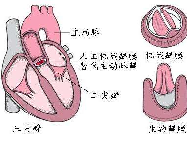 心臟瓣膜置換術(shù)