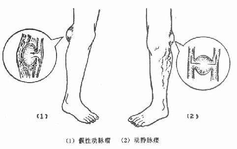動(dòng)靜脈瘺