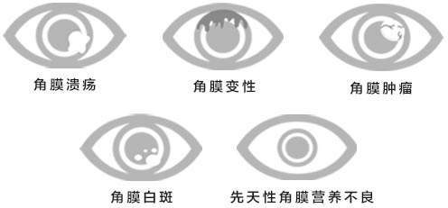角膜營養(yǎng)不良