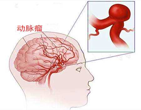 腦動(dòng)脈瘤